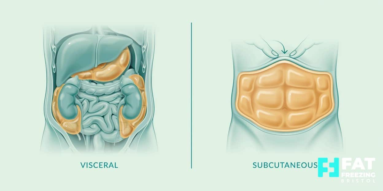 A clean infographic comparing two abdominal cross-sections labelled visceral and subcutaneous fat in a teal and gold clinical style, showing which fat freezing can target